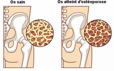Comment prévenir l’ostéoporose?