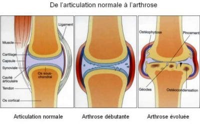 L’arthrose chez les personnes âgées